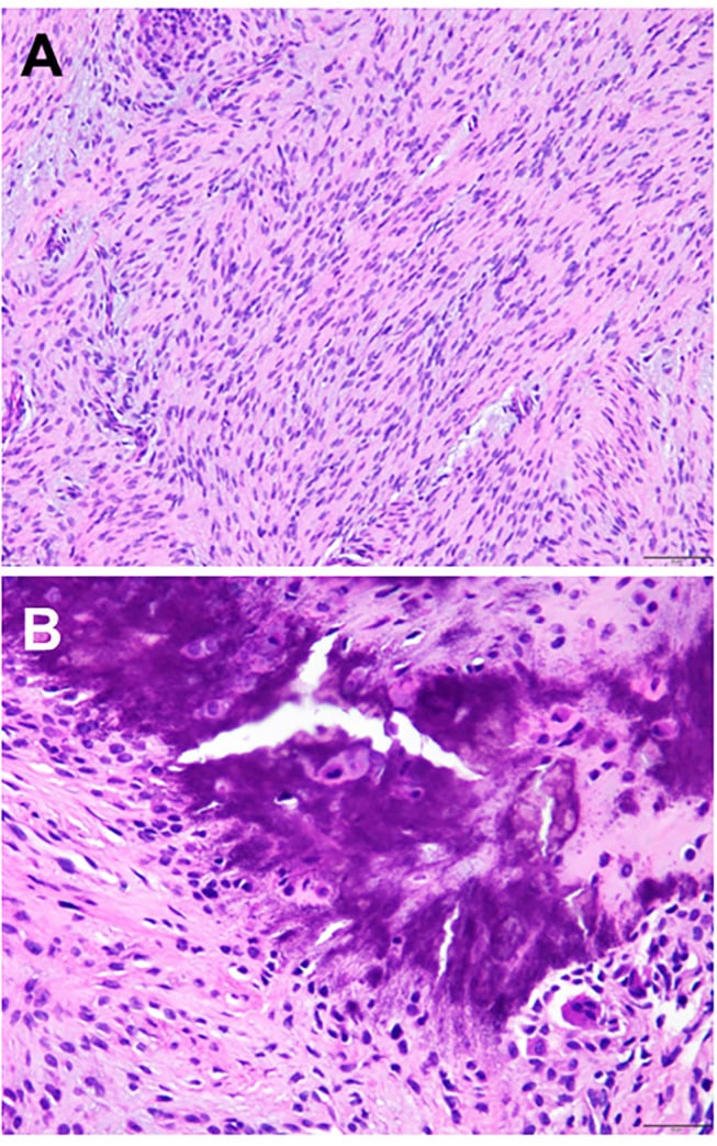 High-power H&E photomicrograph demonstrating chondroid metaplasia and giant cells in CAF