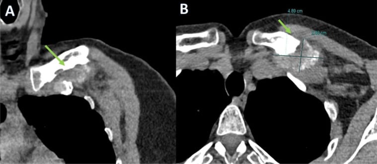 Coronal and axial CT showing chondroid calcification adjacent to the clavicle