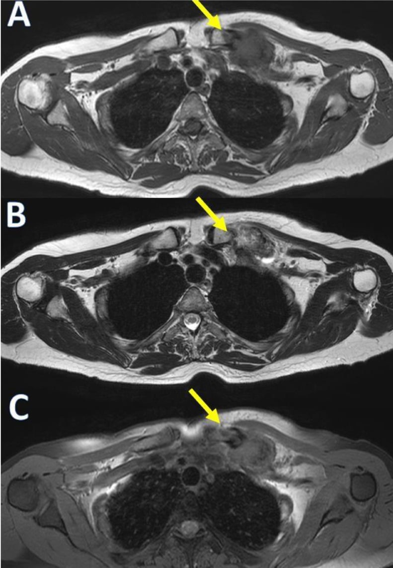 Axial T1, T2 and fat-suppressed MRI showing a calcified soft-tissue mass