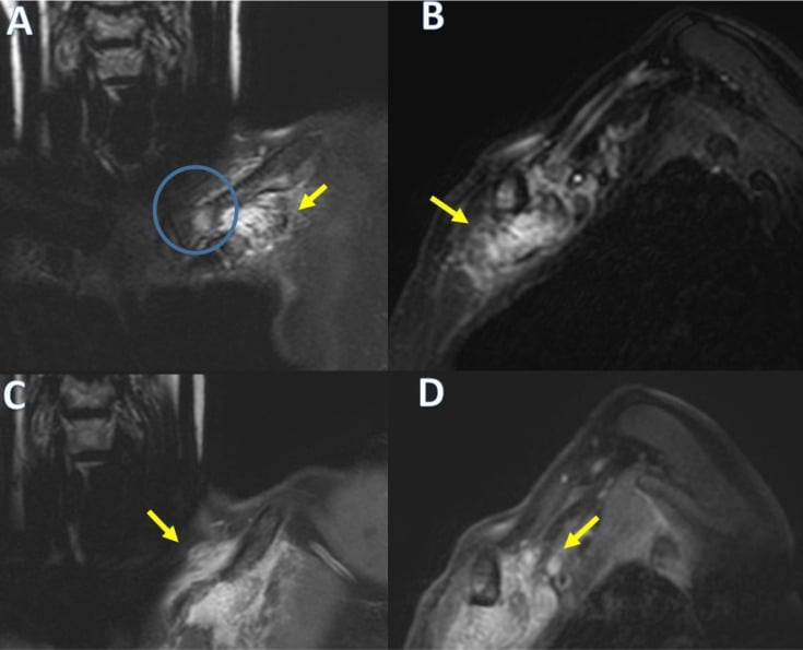 Sagittal and coronal MRI showing lesion extent and enhancement adjacent to the clavicle