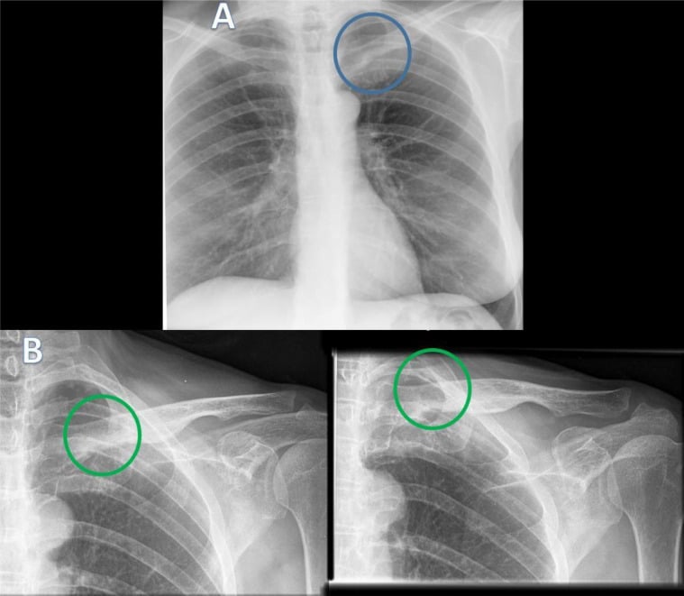 Chest radiograph and two coned clavicle views with the medial clavicle circled, showing soft-tissue opacity and concentric thickening