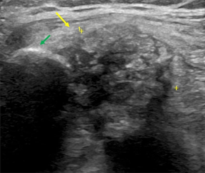 Ultrasound showing echogenic calcific foci within a soft-tissue mass with dense posterior acoustic shadowing