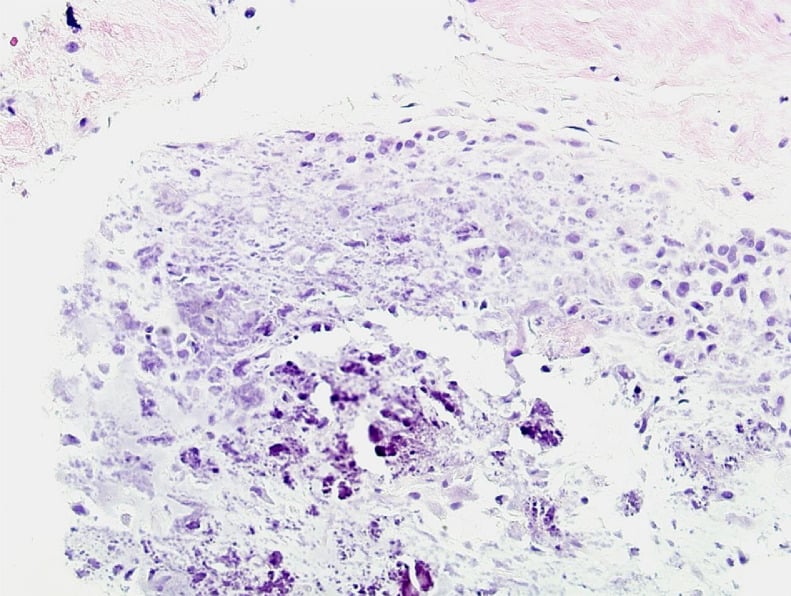Histology showing hypocellular connective tissue and calcified chondromatous proliferation
