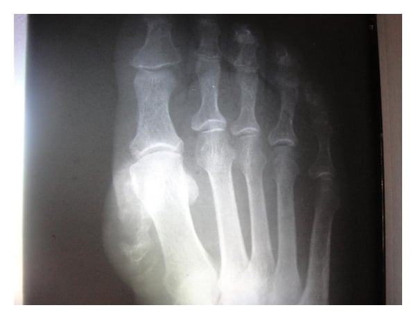 Dorsoplantar forefoot radiograph showing a heavily calcified lobulated soft-tissue mass at the medial first metatarsal head