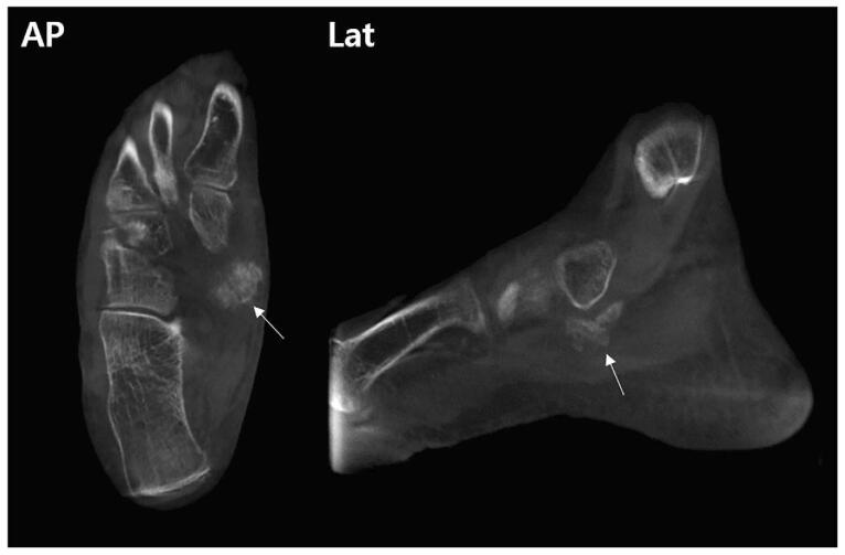 CT showing a calcified soft-tissue mass inferomedial to the navicular