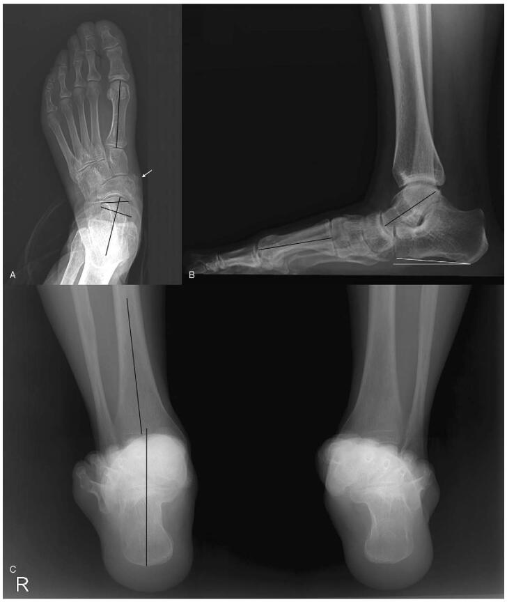 Three weight-bearing foot radiographs with alignment axes drawn and an arrow indicating a calcified lesion medial to the navicular
