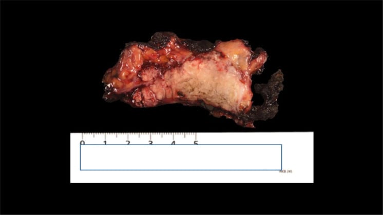Gross calcifying aponeurotic fibroma excision specimen