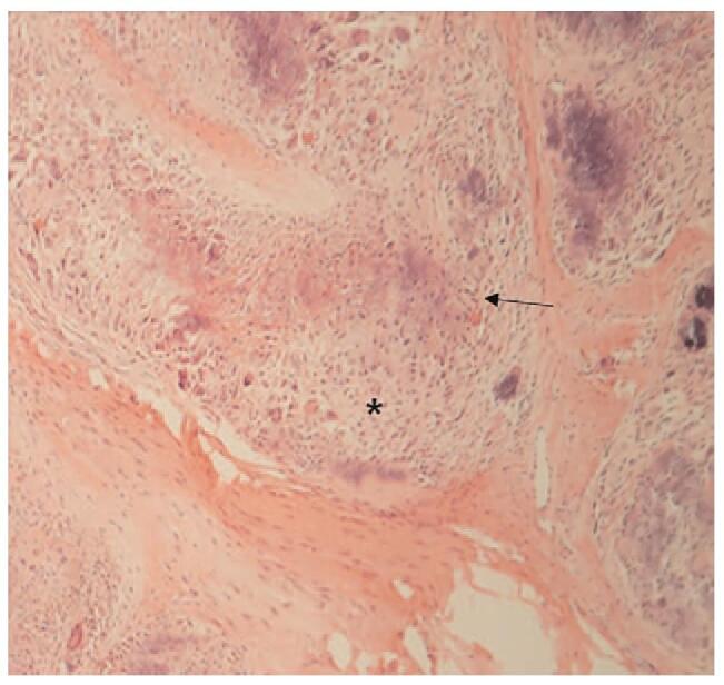 Histology showing chondroid differentiation, central calcification and spindle cells