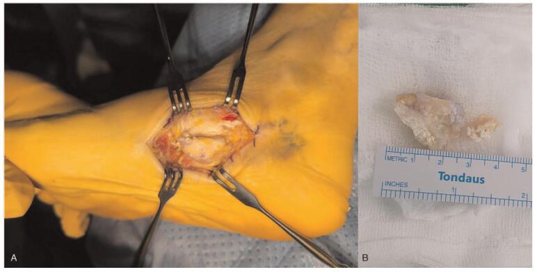 Operative views of calcifying aponeurotic fibroma adherent to posterior tibialis tendon