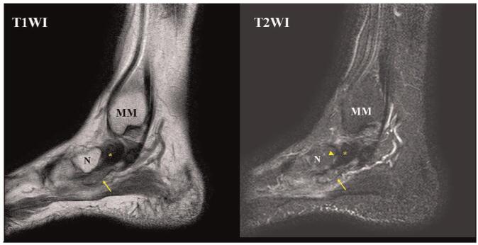 MRI showing calcifying aponeurotic fibroma at the posterior tibialis insertion