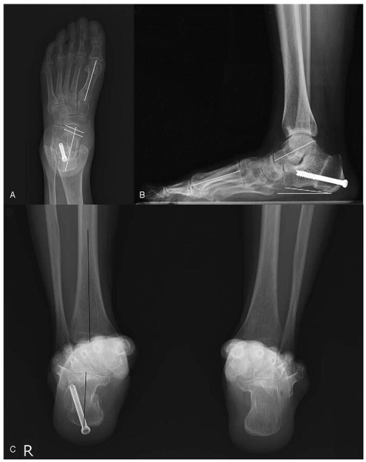 One-year postoperative foot radiographs without recurrent calcified mass