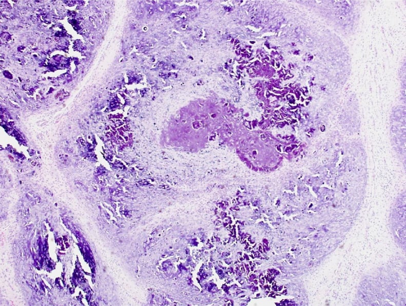 Histology showing spindle cells around metaplastic cartilage and speckled calcification