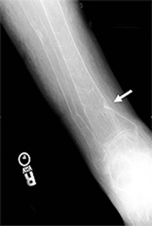 Anteroposterior tibia and fibula radiograph showing osteopenia with Looser zones