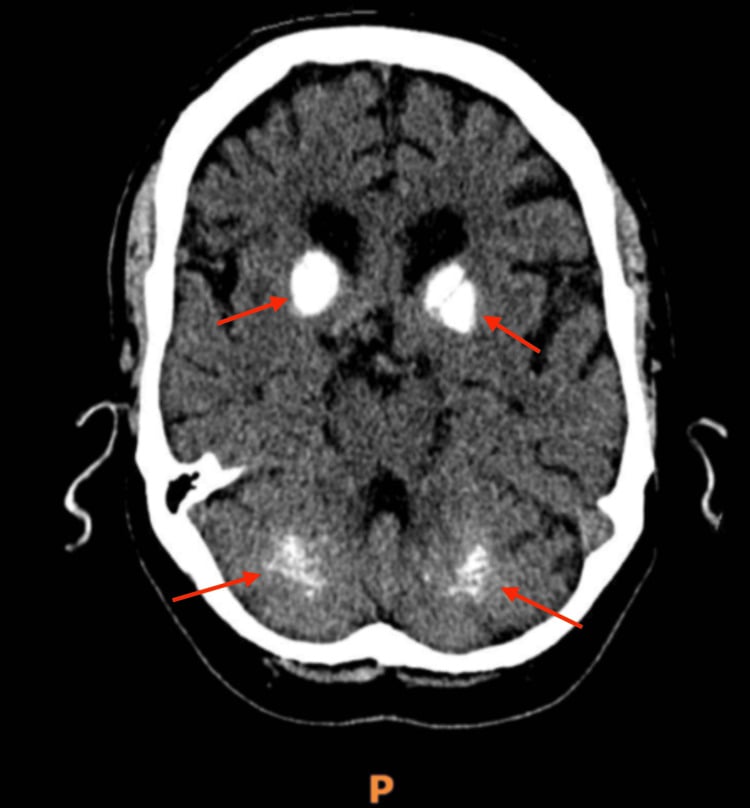 Axial unenhanced CT of the brain showing symmetric basal ganglia and dentate nucleus calcification