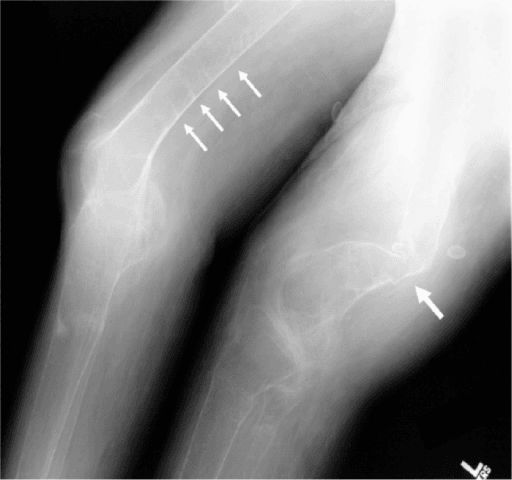 Radiograph of the distal femora showing deformity and multiple pseudofractures in severe osteomalacia