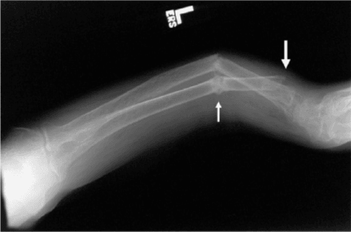 Lateral forearm radiograph showing demineralisation and fractures at different stages of healing