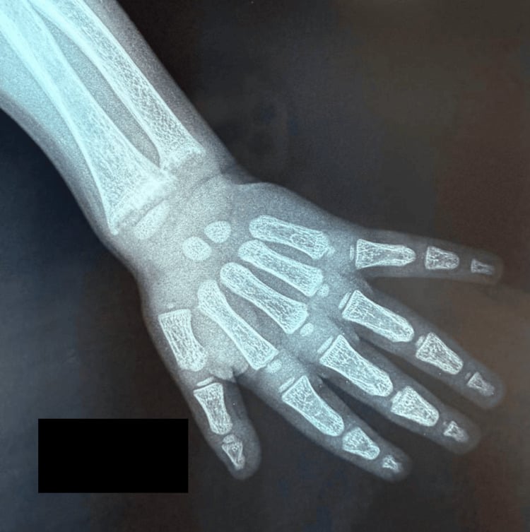Hand and wrist radiograph showing metaphyseal changes of active rickets