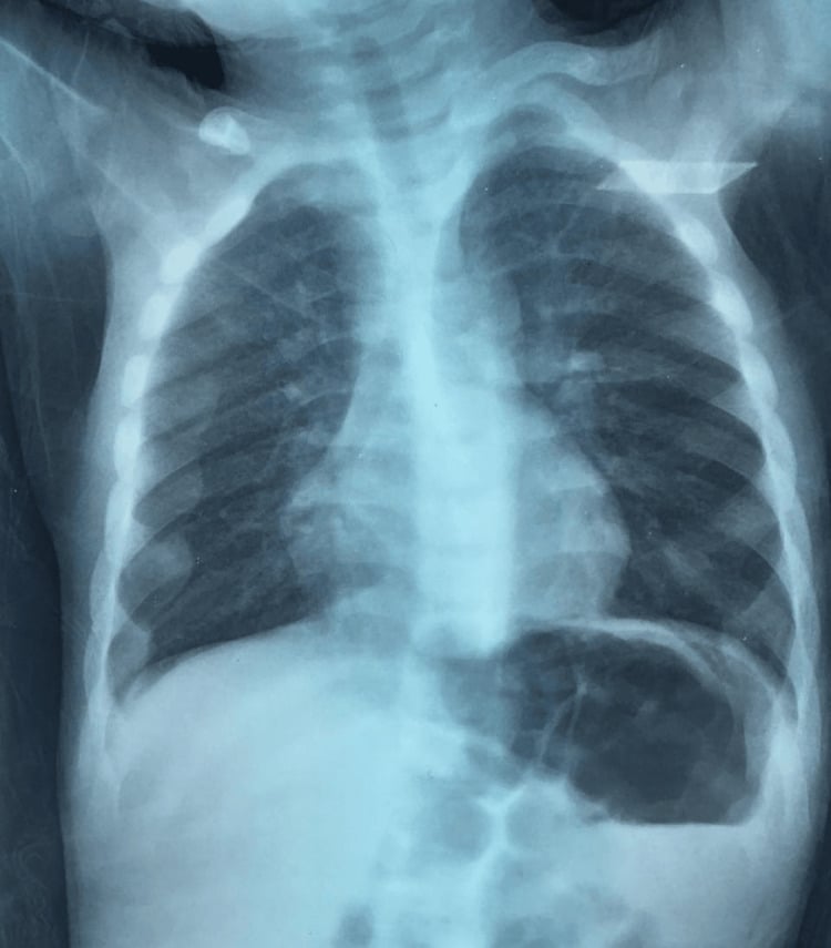 Chest radiograph showing rachitic rosary from expanded costochondral junctions