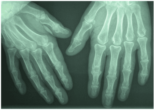 Hand radiograph showing symmetrical subperiosteal resorption of the terminal phalanges