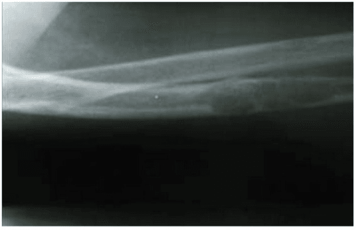 Lateral forearm radiograph showing an osteitis fibrosa cystica lesion of the ulna with pathological fracture
