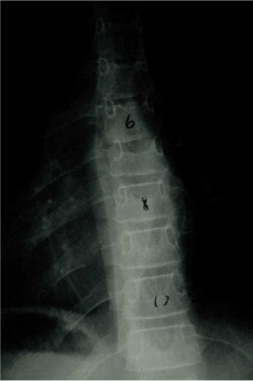 Spine radiograph showing an osteoporosis-related T7 vertebral fracture