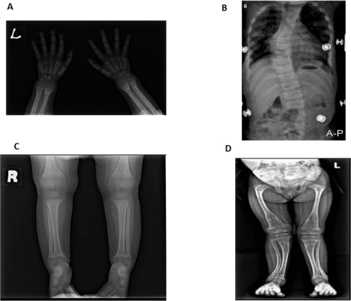 Four-panel skeletal survey of a child with rickets showing hands, chest and bowed legs