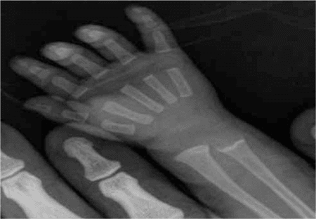 Radiograph of a child's hand and wrist in rickets showing metaphyseal cupping and fraying