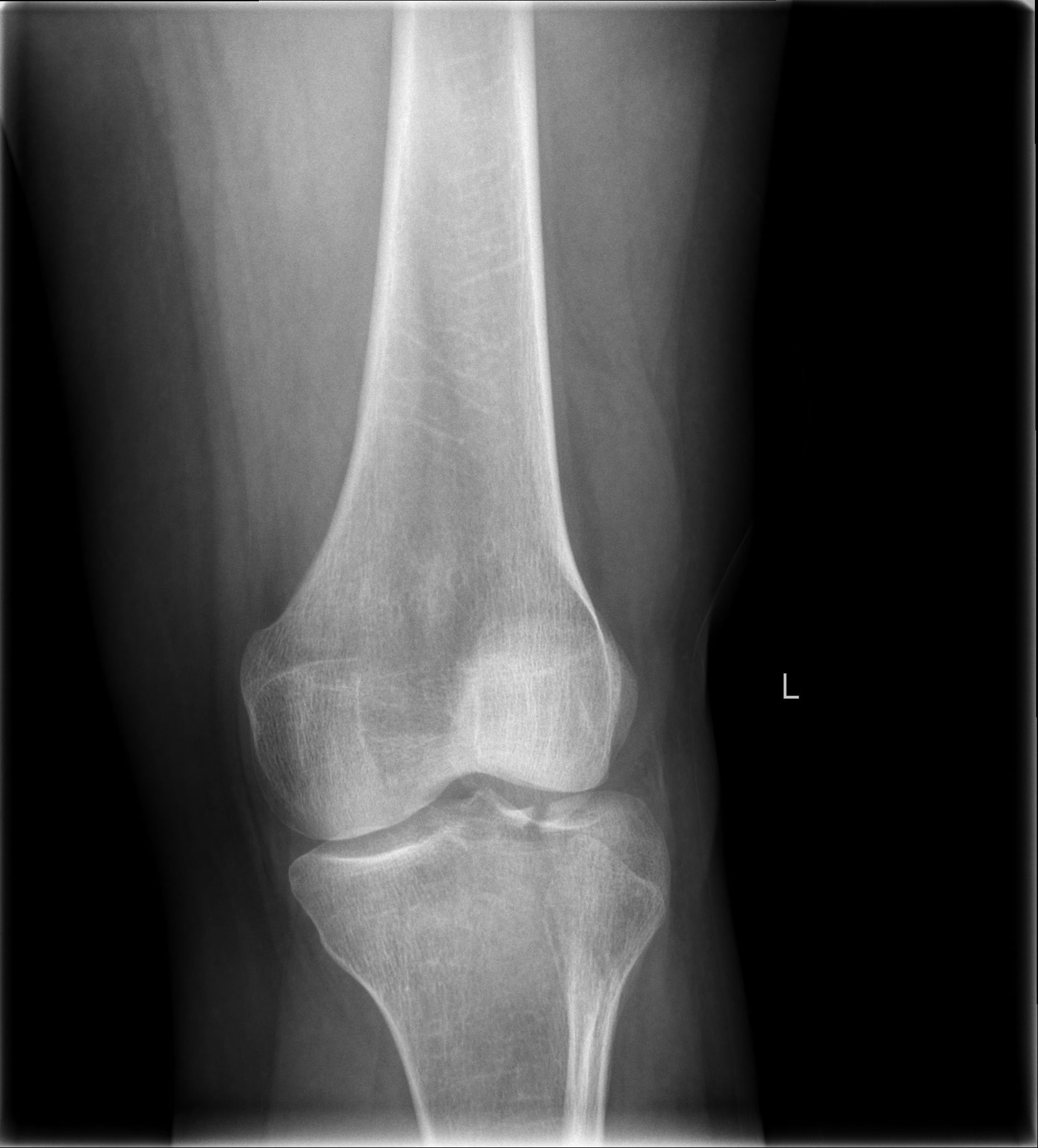 AP knee radiograph showing a lateral tibial plateau depression fracture