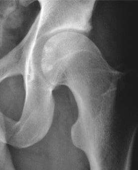 AP radiograph of the hip demonstrating cam-type femoroacetabular impingement with pistol grip deformity
