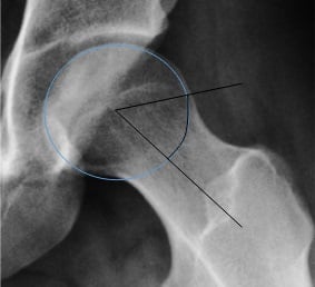 Alpha angle measured on a 45-degree Dunn view of the hip, showing the best-fit circle and neck-axis construction