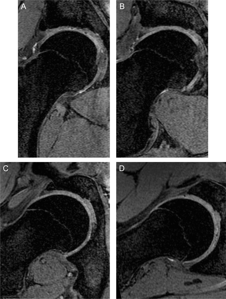 Four radial MRI slices, labelled A to D, of an adolescent hip showing cam morphology from 12 to 3 o'clock
