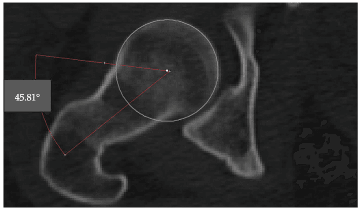 CT image showing alpha-angle construction with a best-fit femoral-head circle and neck axis, measuring 45.81 degrees