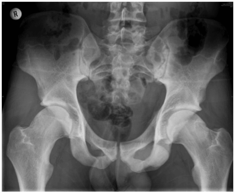 Anteroposterior pelvis radiograph of an athlete showing bilateral cam deformities and lateral epiphyseal extension