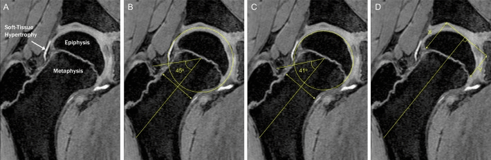 One radial MRI slice of a developing hip shown four times, labelled with soft-tissue hypertrophy, epiphysis and metaphysis and with angle and length measurements