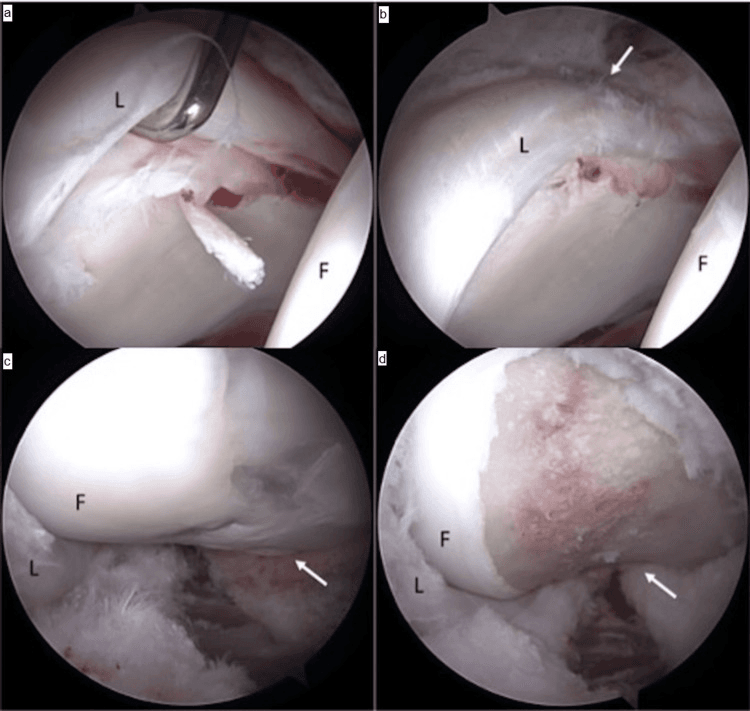 Hip arthroscopy showing a probe displacing the separated labrum and the labrum after repair