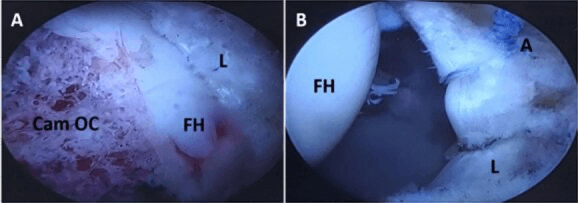Arthroscopic views labelled Cam OC, FH, L and A showing cam osteochondroplasty and a labral suture anchor