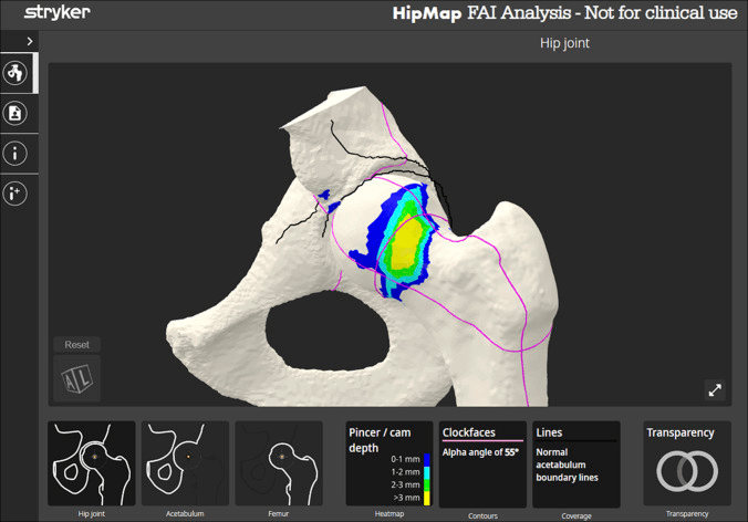 Three-dimensional hip mapping software showing a colour heatmap of cam depth and alpha-angle clock-face contours