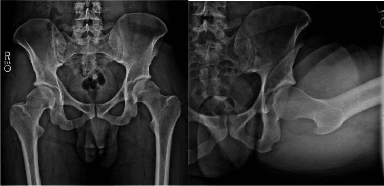 Anteroposterior pelvis and lateral hip radiographs showing symptomatic cam morphology with an alpha angle of 71 degrees