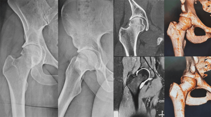 Radiographs, CT, MR arthrography and three-dimensional CT reconstructions of a hip with combined femoroacetabular impingement