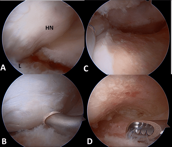 Arthroscopic views of the head-neck junction and labrum, with instruments in two panels