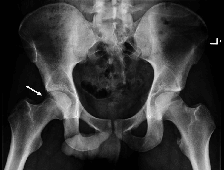 Postoperative pelvis radiograph with an arrow at the corrected right femoral head-neck junction after osteochondroplasty, the alpha angle reduced to 46 degrees