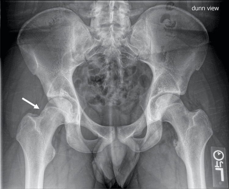 Preoperative pelvis radiograph labelled dunn view, with an arrow at a cam lesion of the right femoral head-neck junction and an alpha angle of 72 degrees