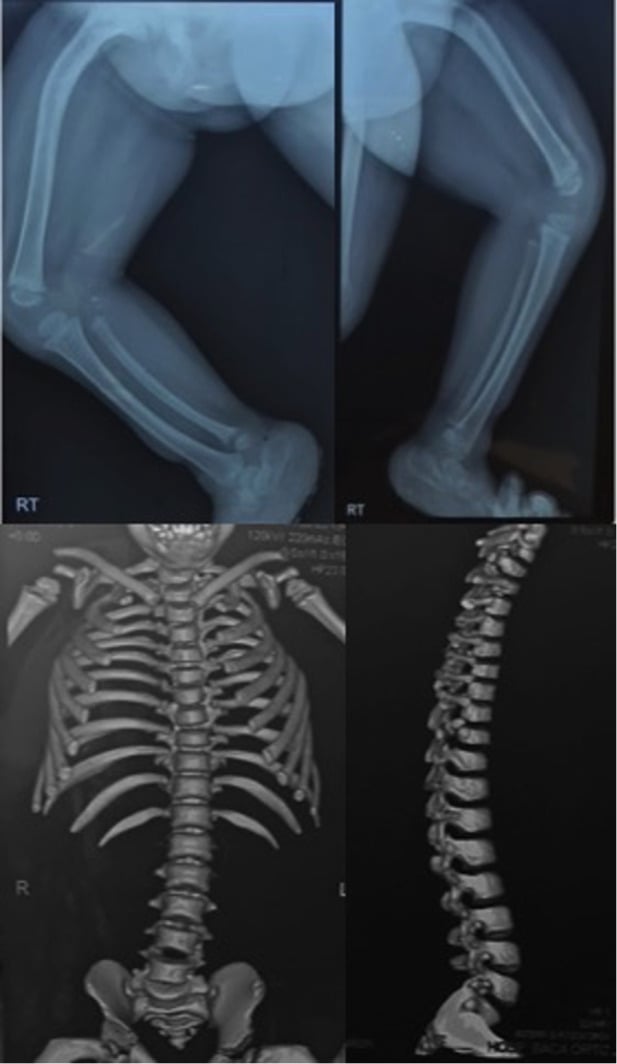 Radiograph showing bowed tibia and fibula with CT of thoracic scoliosis in campomelic dysplasia