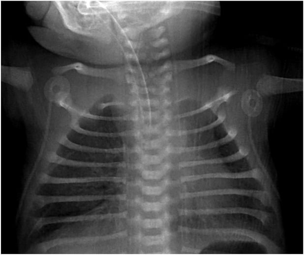 Chest radiograph demonstrating hypoplastic scapulae and thin wavy ribs in Campomelic dysplasia