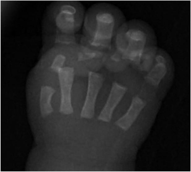 Hand radiograph demonstrating short first metacarpal bone
