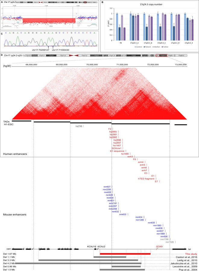 Array CGH genomic profile map demonstrating 17q24.3 deletion modulating SOX9