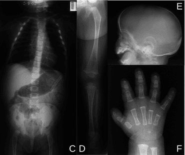 Skeletal survey of an acampomelic (straight-boned) case of campomelic dysplasia