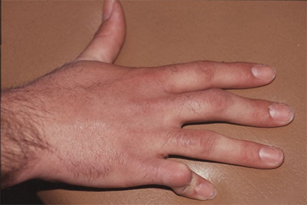 Clinical photograph of a hand with camptodactyly of the small finger - a fixed PIP flexion posture while the other digits rest flat.