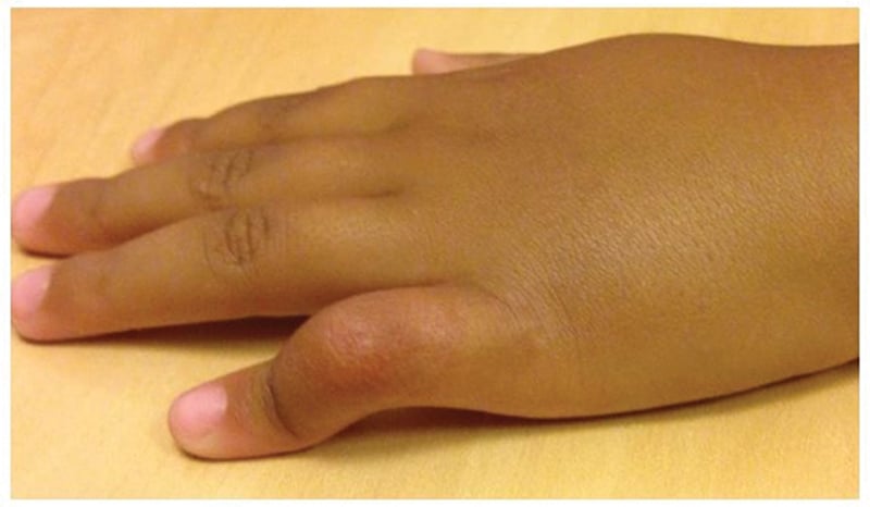 Dorsal clinical photograph showing small-finger PIP flexion camptodactyly.