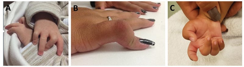Three clinical hand photographs, panels A to C, comparing infantile, adolescent and multidigit camptodactyly patterns.